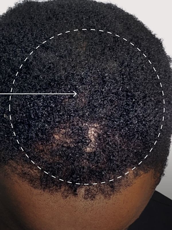 Close-up of scalp showing hair loss area.