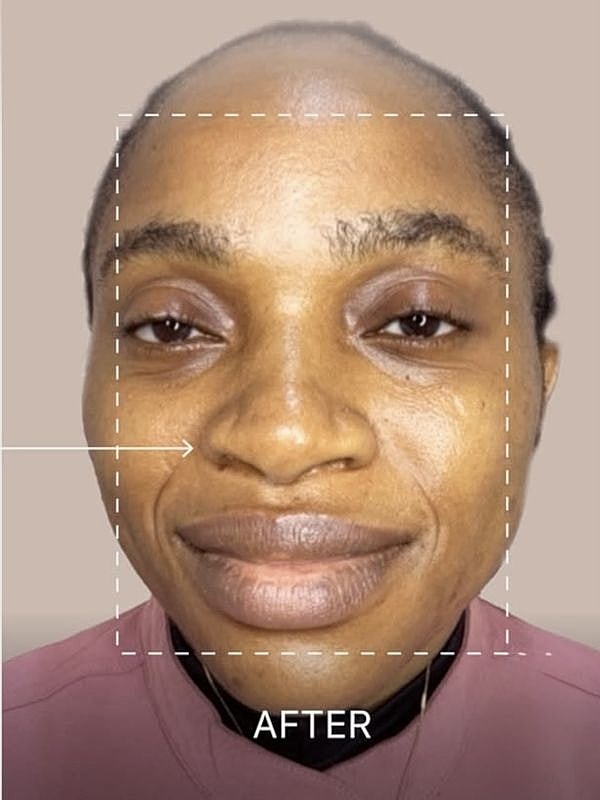 Facial transformation before and after treatment.