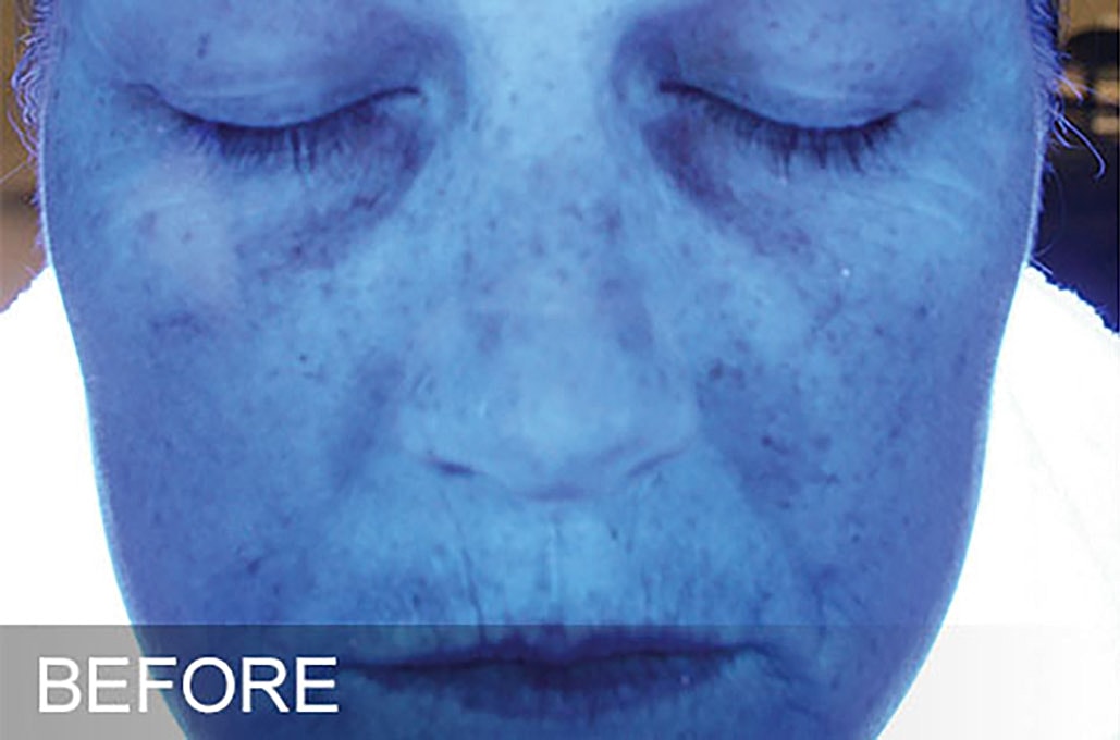 Hydrafacial Before & After