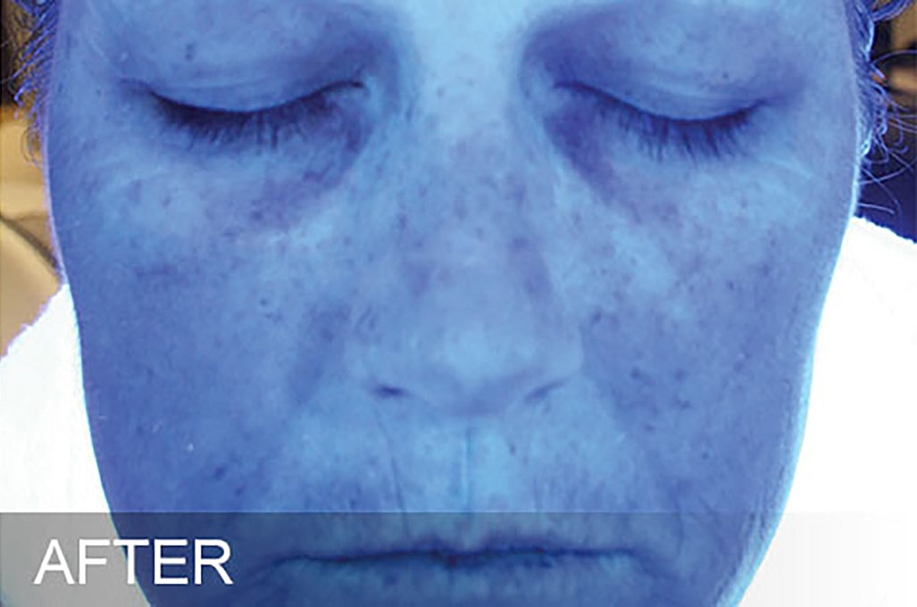 Hydrafacial Before & After