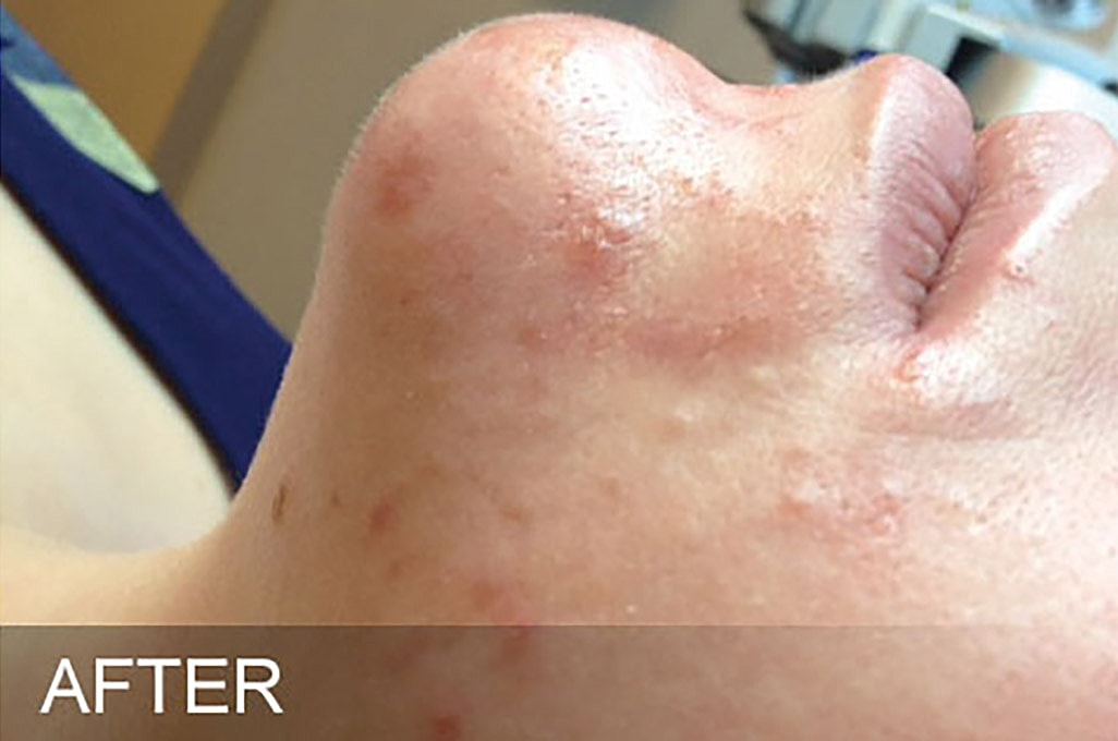 Hydrafacial Before & After