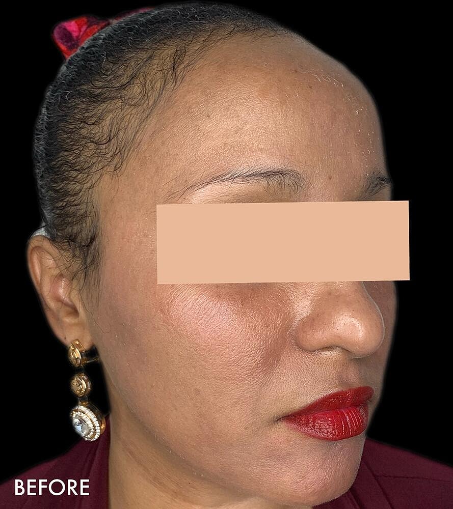 Hydrafacial Before & After