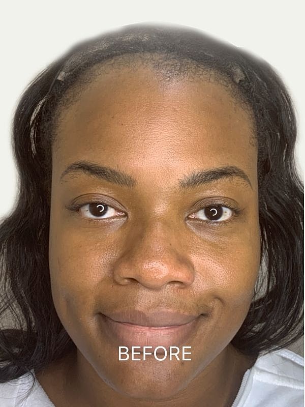 Before cosmetic treatment facial photo, natural lighting.