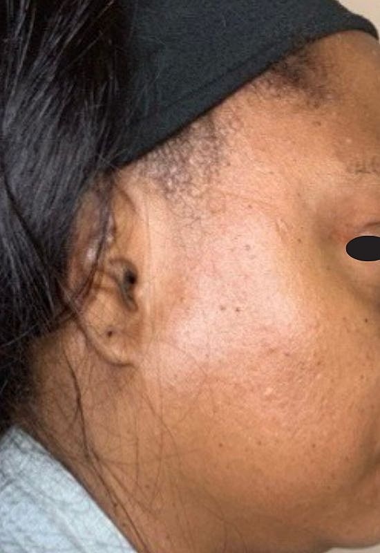 Hydrafacial Before & After