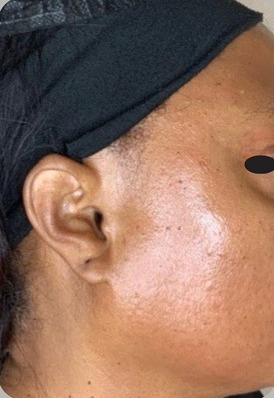Hydrafacial Before & After