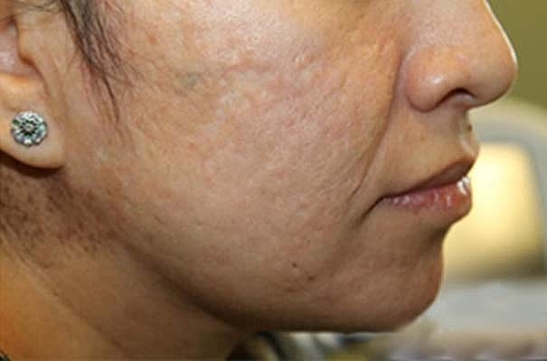 Laser Skin Treatments Before & After