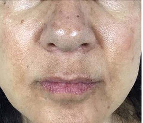 Laser Skin Treatments Before & After