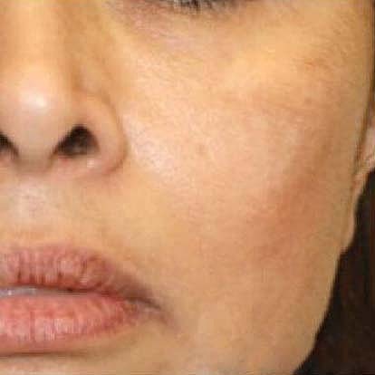 Laser Skin Treatments Before & After