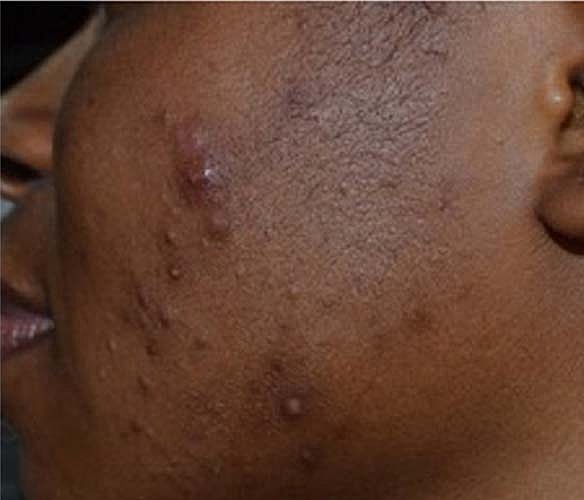 Laser Skin Treatments Before & After