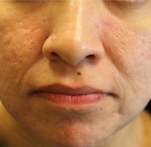 Laser Skin Treatments Before & After