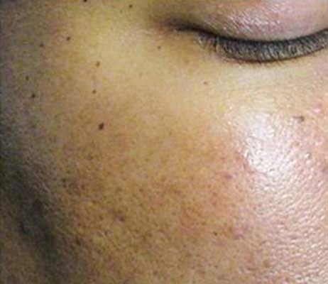 Laser Skin Treatments Before & After