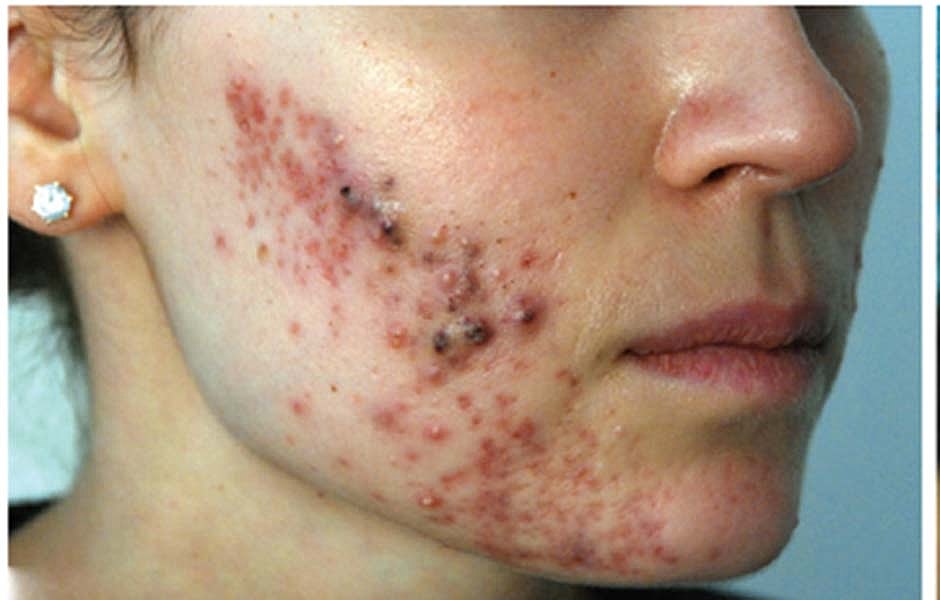 Laser Skin Treatments Before & After