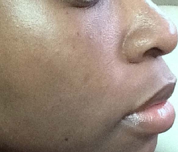 Laser Skin Treatments Before & After