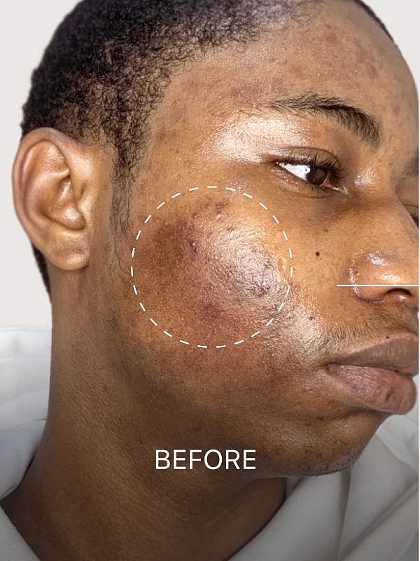 Acne before treatment on a person's cheek.