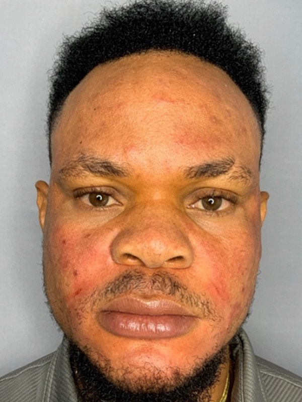 Smile Lines And Nasolabial Fold Fillers Before & After