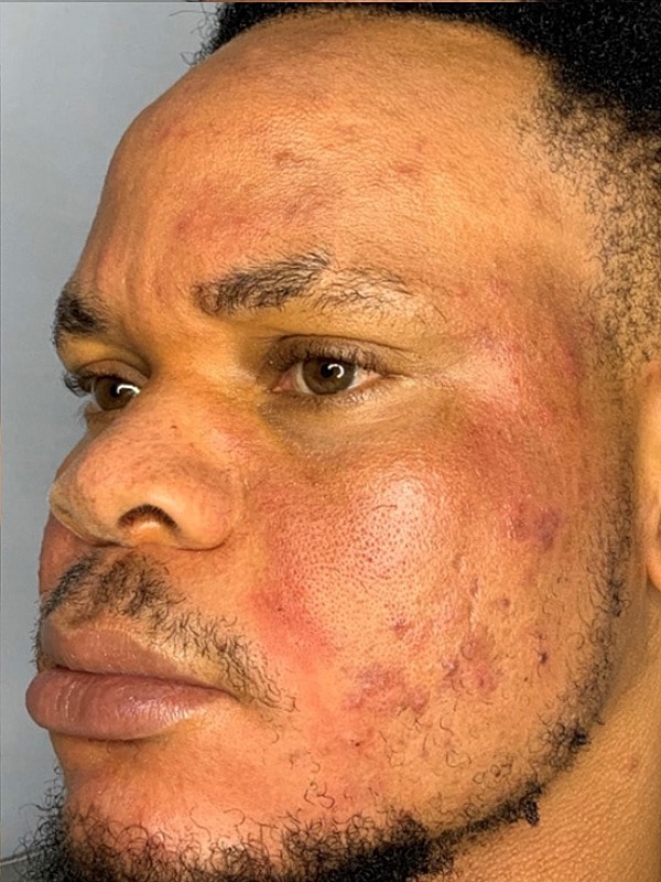 Smile Lines And Nasolabial Fold Fillers Before & After