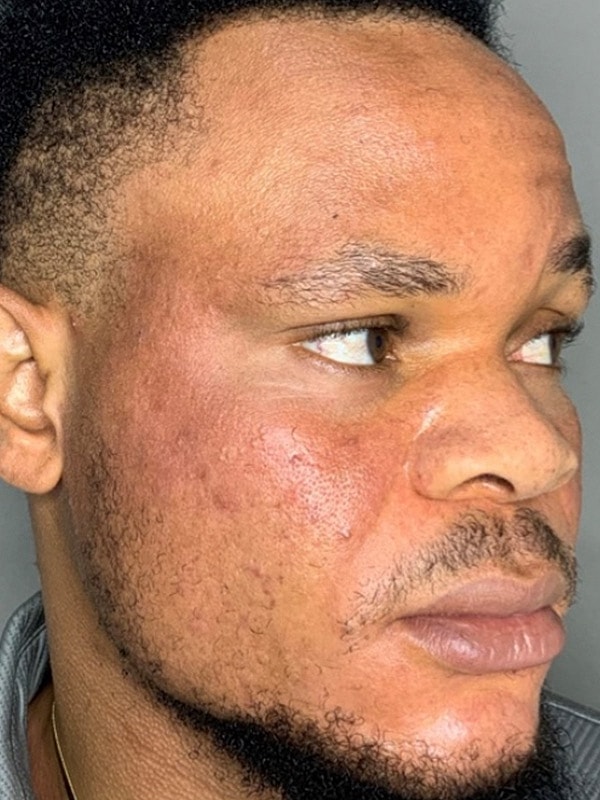 Smile Lines And Nasolabial Fold Fillers Before & After