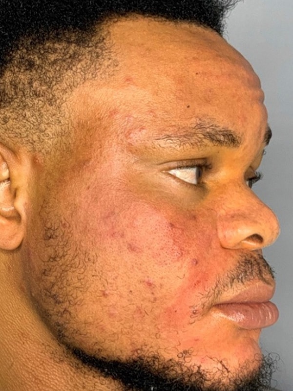 Smile Lines And Nasolabial Fold Fillers Before & After