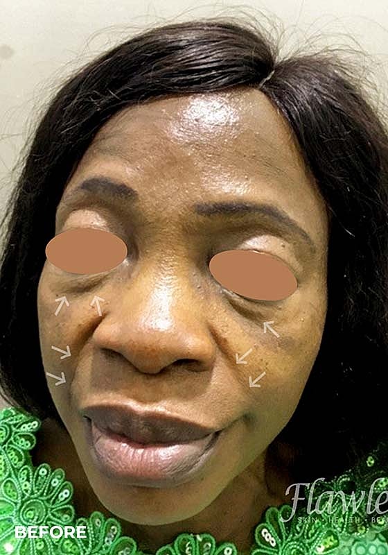 Smile Lines And Nasolabial Fold Fillers Before & After