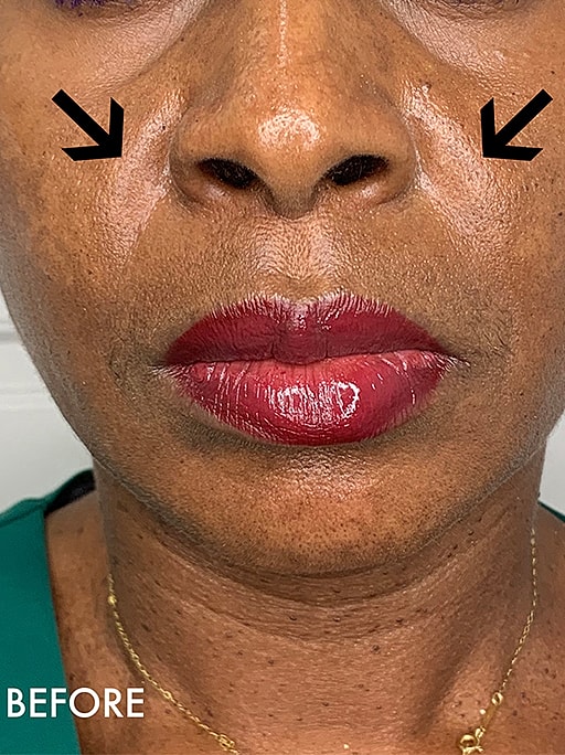 Smile Lines And Nasolabial Fold Fillers Before & After