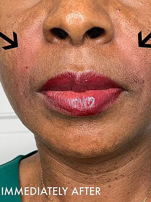 Smile Lines And Nasolabial Fold Fillers Before & After