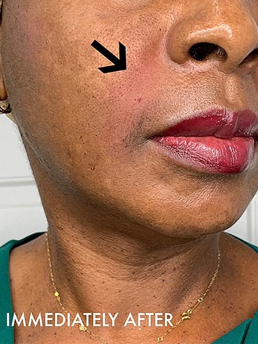 Smile Lines And Nasolabial Fold Fillers Before & After