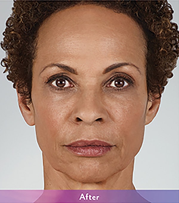 Smile Lines And Nasolabial Fold Fillers Before & After