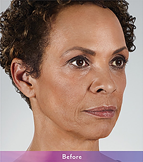 Smile Lines And Nasolabial Fold Fillers Before & After