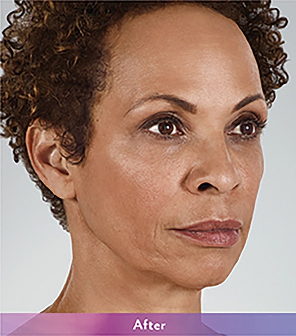 Smile Lines And Nasolabial Fold Fillers Before & After