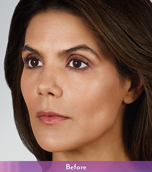 Smile Lines And Nasolabial Fold Fillers Before & After