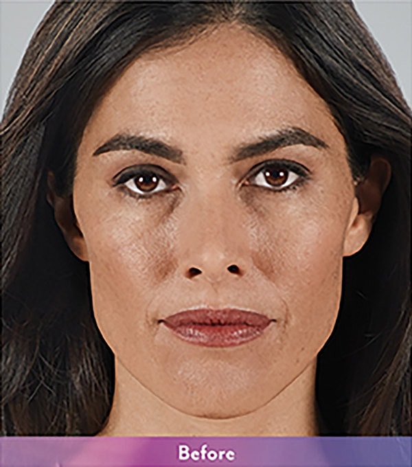 Smile Lines And Nasolabial Fold Fillers Before & After