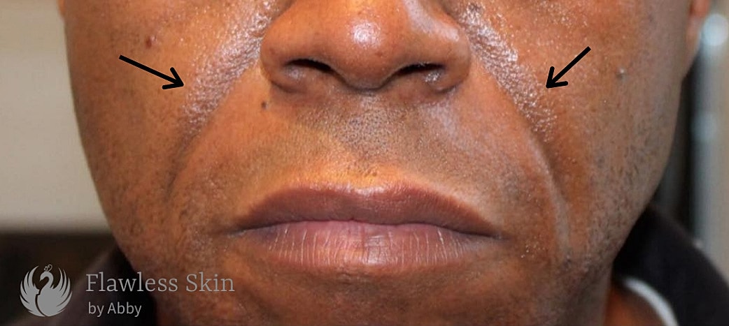 Smile Lines And Nasolabial Fold Fillers Before & After