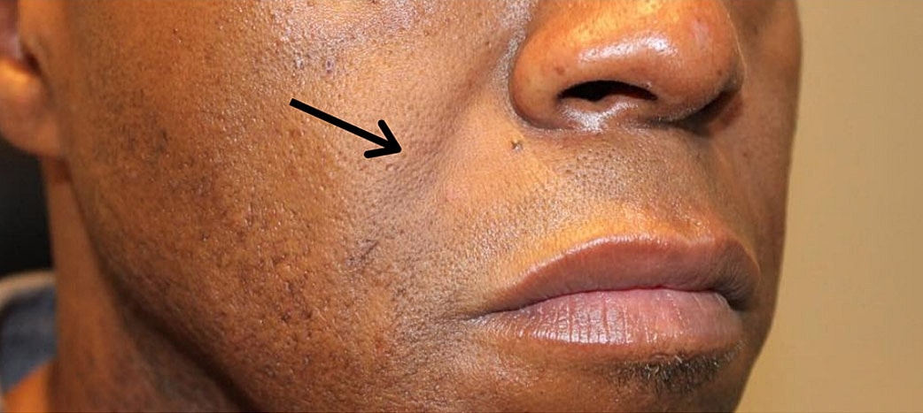 Smile Lines And Nasolabial Fold Fillers Before & After