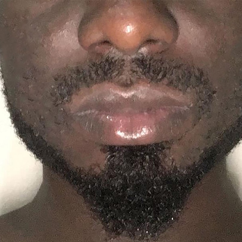 Smile Lines And Nasolabial Fold Fillers Before & After