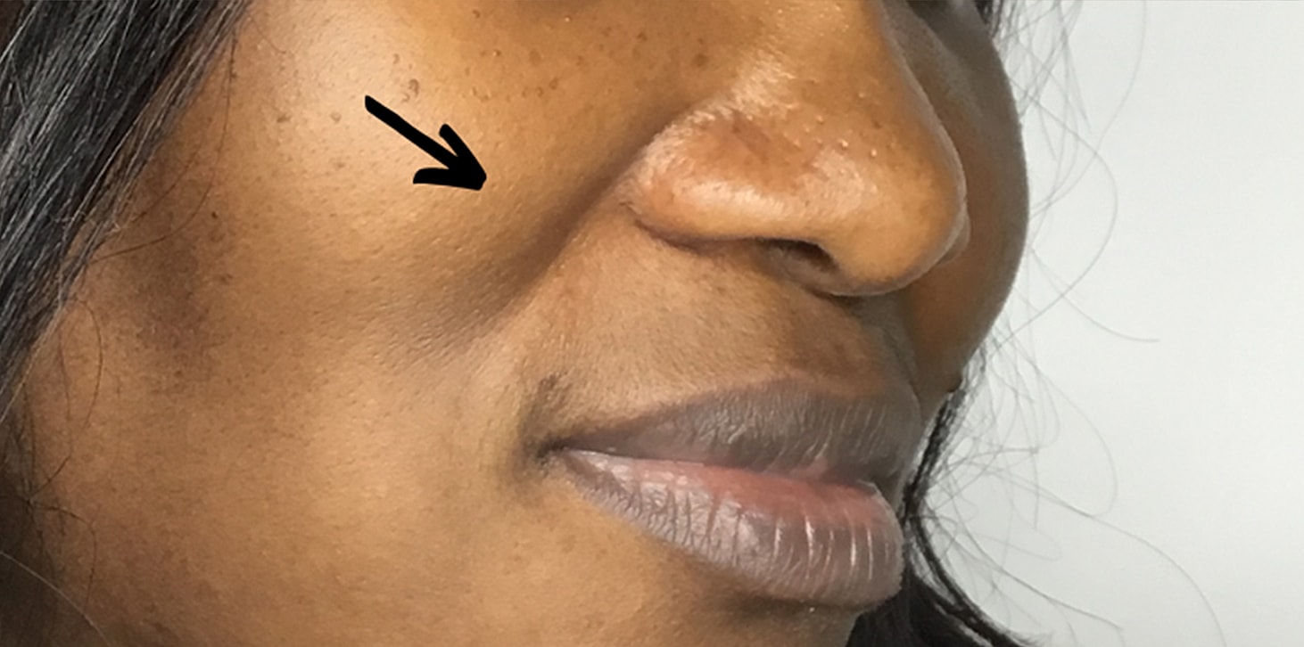 Smile Lines And Nasolabial Fold Fillers Before & After