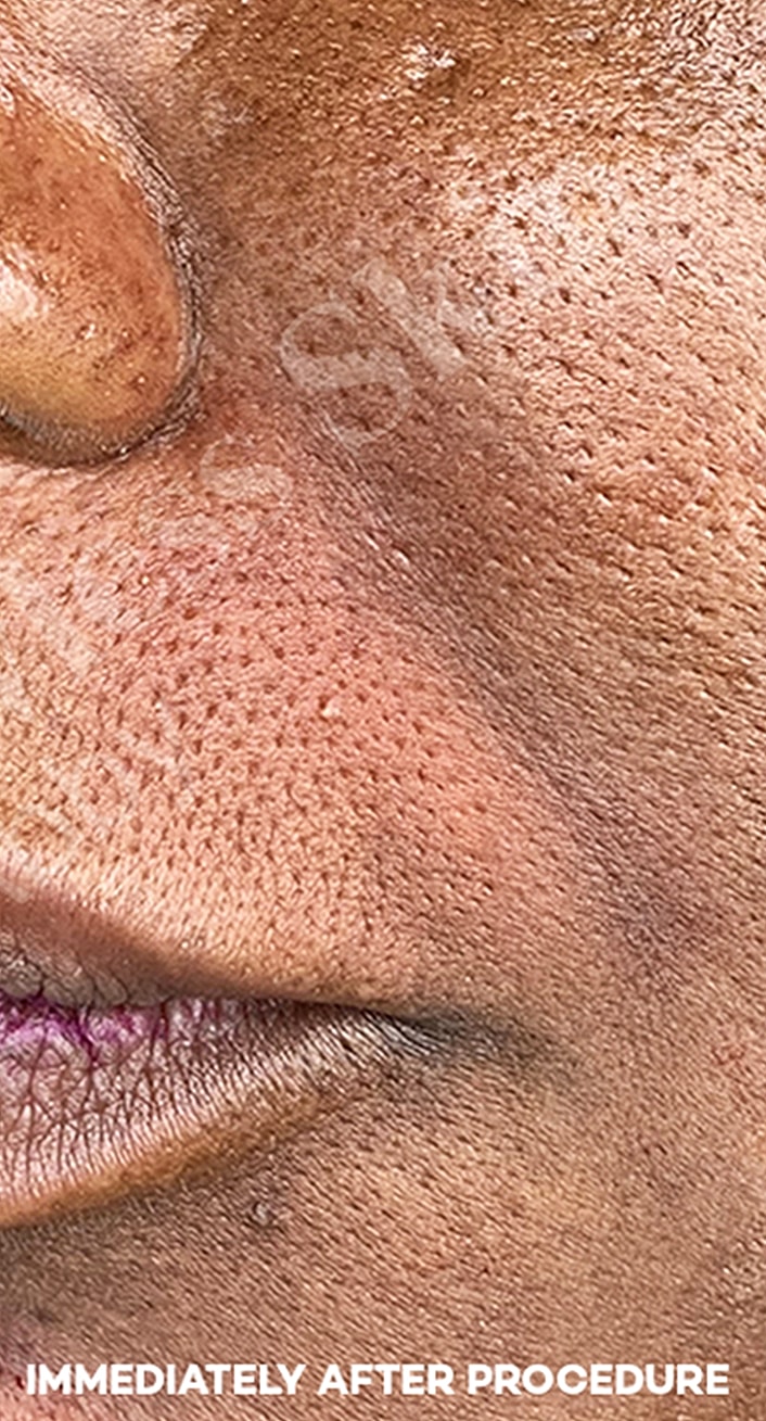 Smile Lines And Nasolabial Fold Fillers Before & After