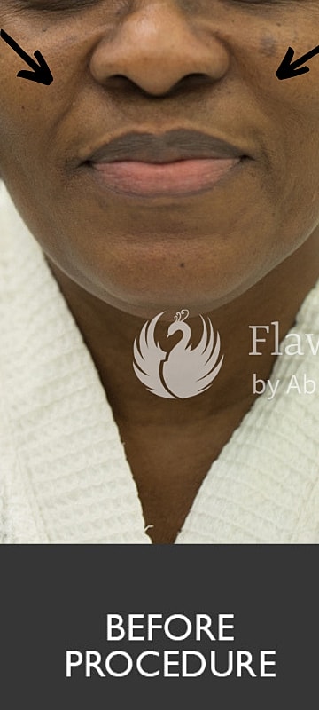 Smile Lines And Nasolabial Fold Fillers Before & After