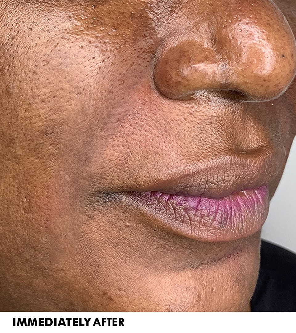 Smile Lines And Nasolabial Fold Fillers Before & After