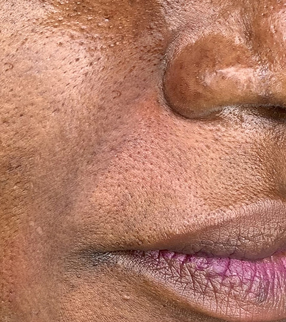 Smile Lines And Nasolabial Fold Fillers Before & After