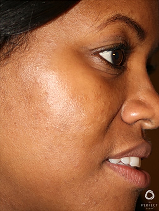 Specialty Peels Before & After