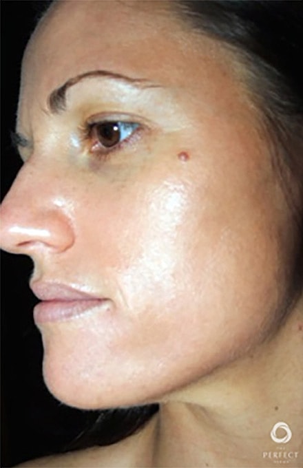 Specialty Peels Before & After