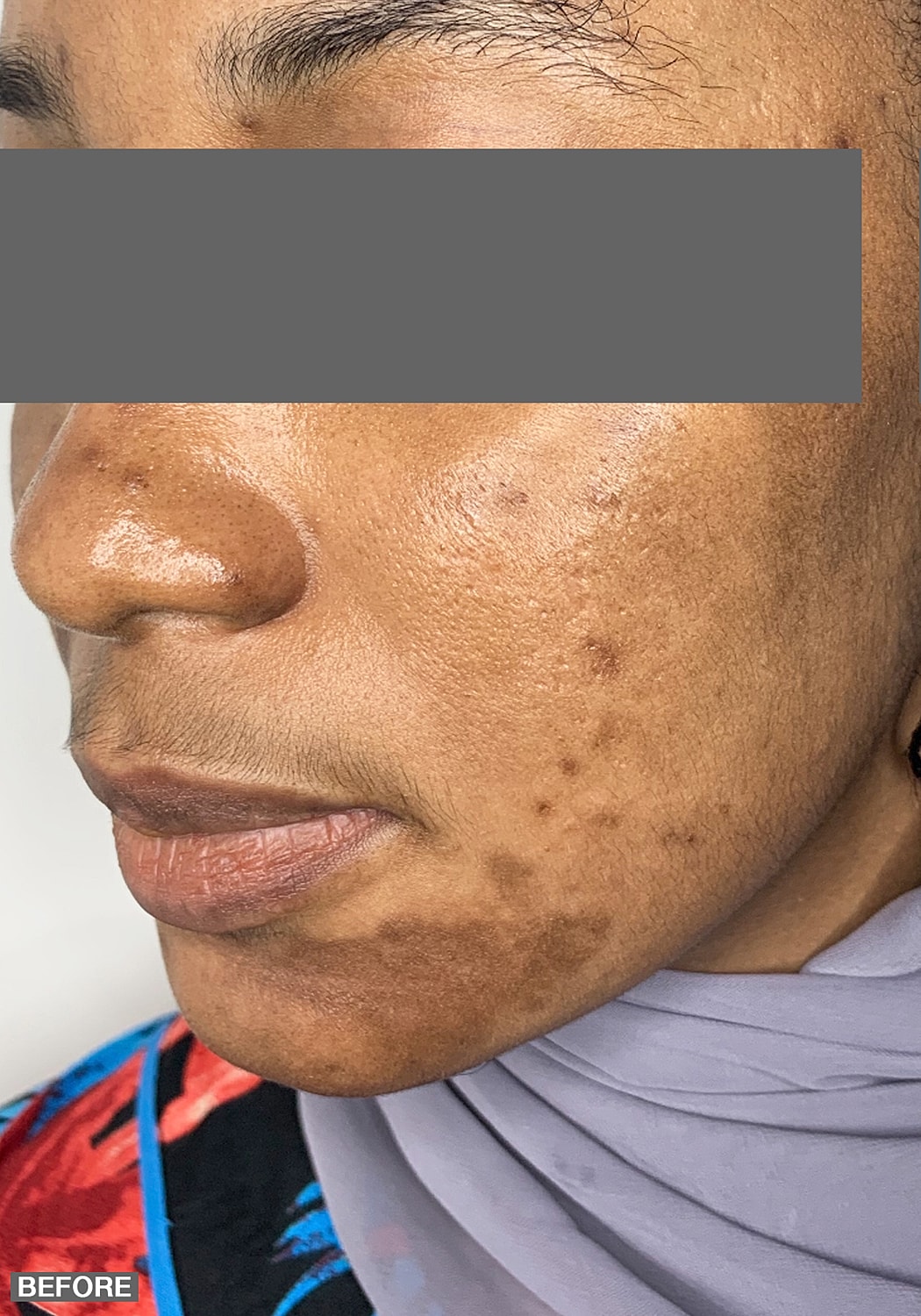 Specialty Peels Before & After