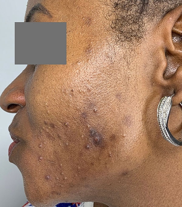 Chemical Peels Before & After