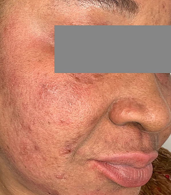 Chemical Peels Before & After