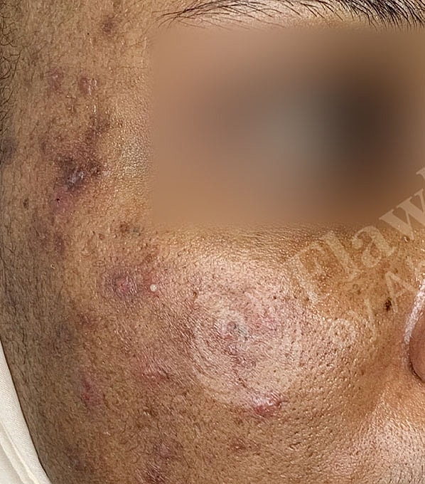 Chemical Peels Before & After