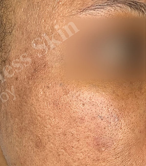 Chemical Peels Before & After