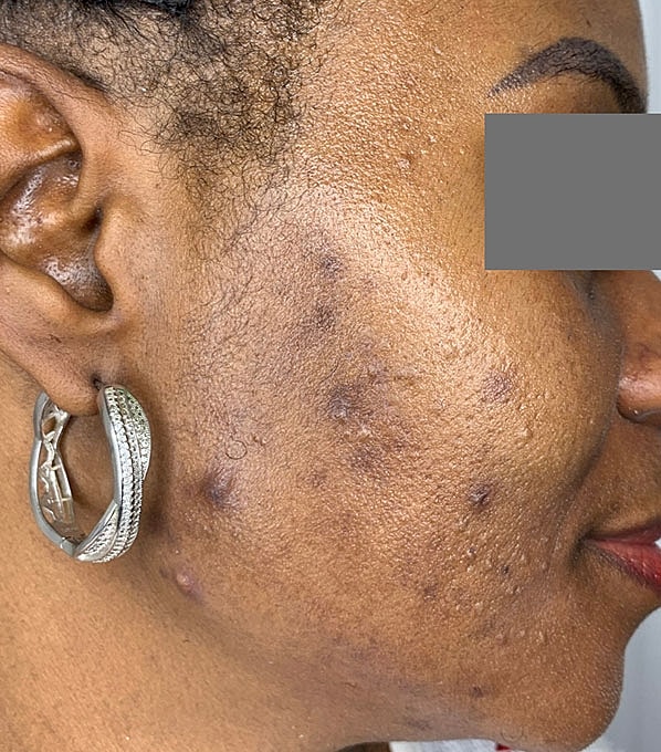 Chemical Peels Before & After