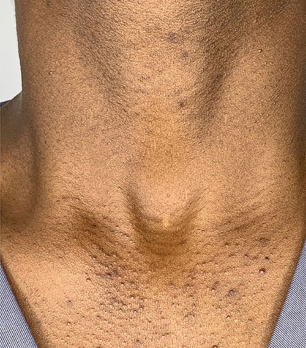 Chemical Peels Before & After