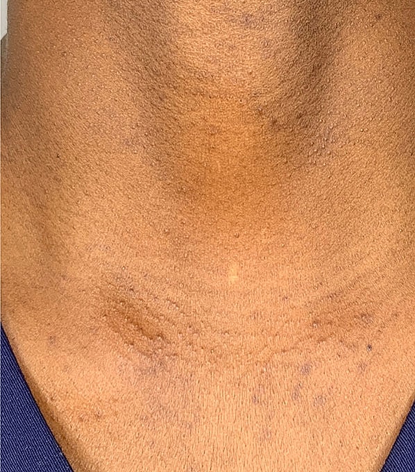 Chemical Peels Before & After