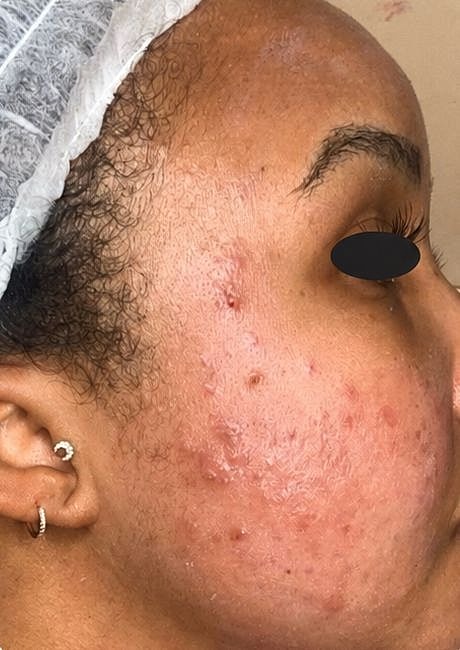 Chemical Peels Before & After
